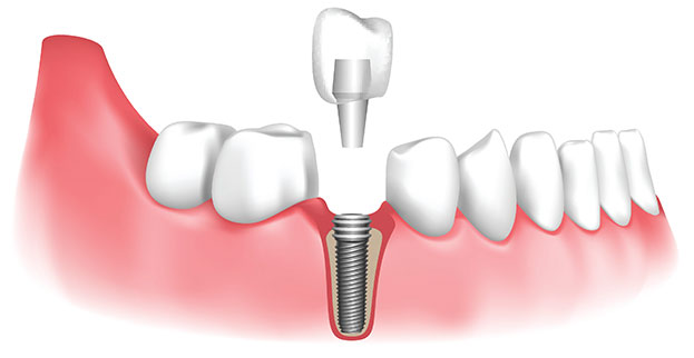 How dental implants are placed
