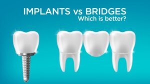 Implants vs bridges .. what is best for you?