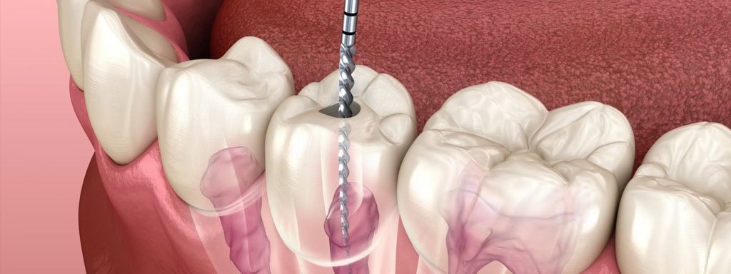 Root Canal Treatment (RCT)