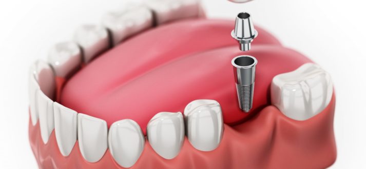 instant dental implant