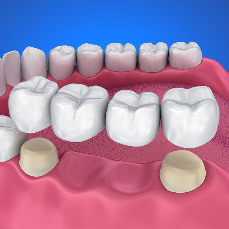 Dental bridge and Crown