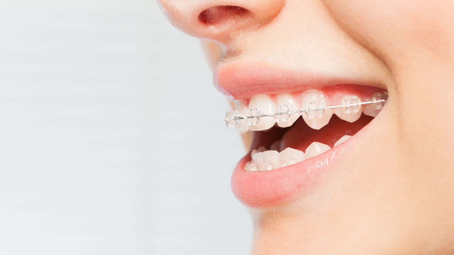 about ceramic braces Treatment