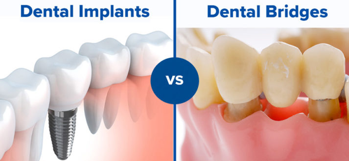 Implants vs bridges .. what is best for you?