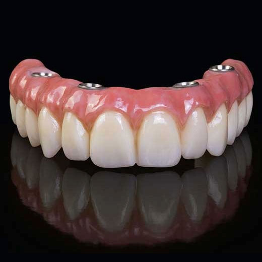 Implant Supported Denture Hybrid Denture
