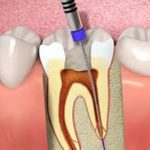 Root Canal Treatment 1