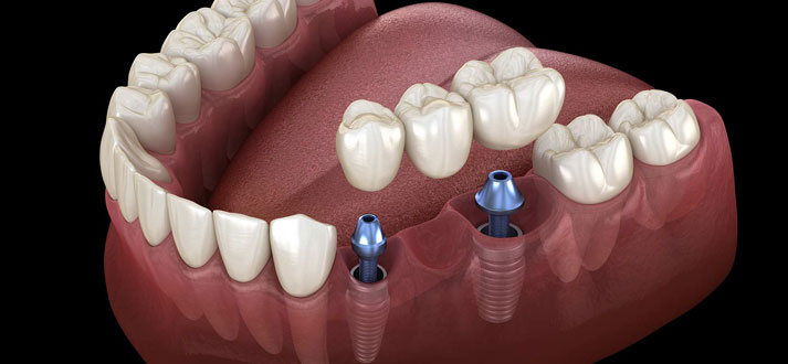 Things About Dental Implants You Should Know ! - Partha Dental Hair