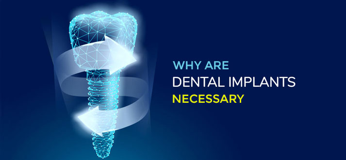 Why are dental implants necessary