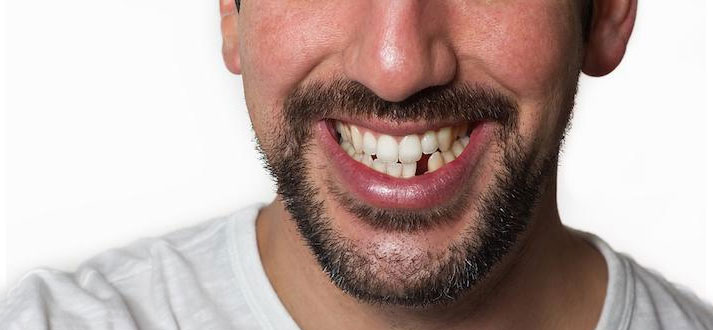 Why Should You Replace Missing Teeth?