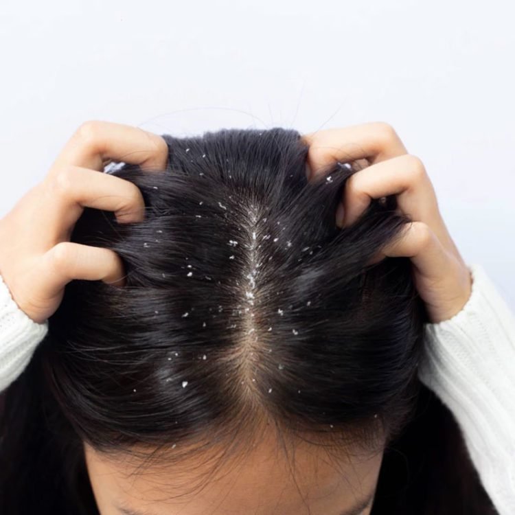 Anti Dandruff Treatment