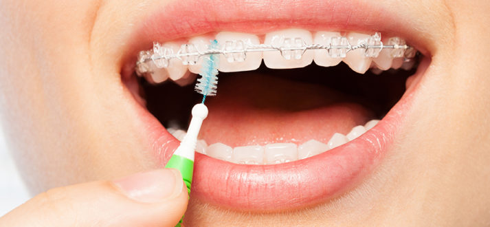 How to keep your braces clean and hygienic