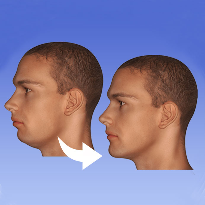 Jaw Surgery | Best Oral And Maxillofacial 1