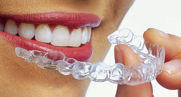 Clear Aligners – Get To Know Them | Partha Clinic - 130+