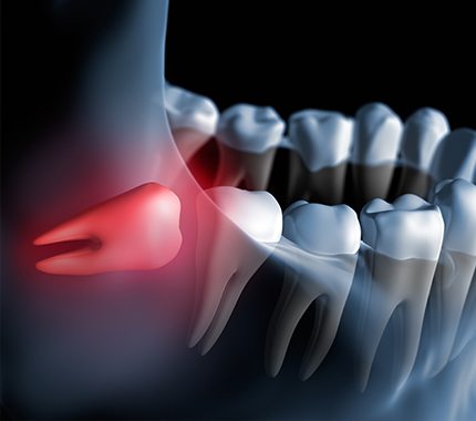 Wisdom Tooth Extraction Is Best At Partha Dental Clinic 130+
