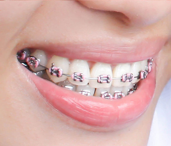 Dental Braces | Best At Partha Dental Clinic | 130+ Clinics