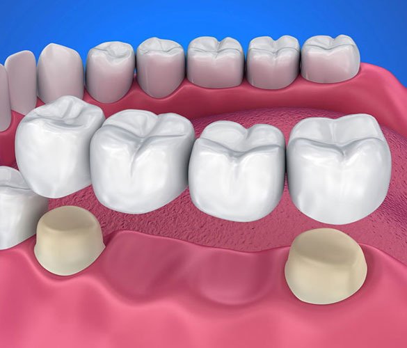 dental bridge and crown