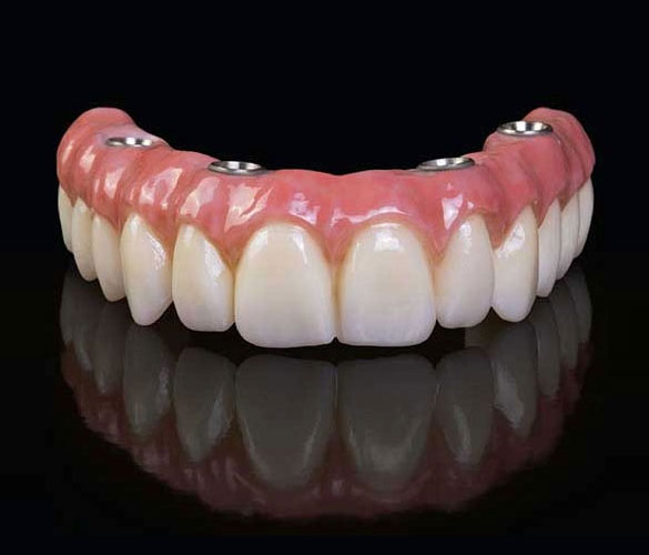 Hybrid Dentures Are Easy At Partha Dental - 130+ Clinics