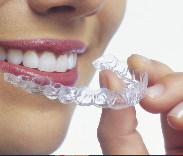 Tooth Aligners, Invisible Aligners Partha Dental Hair Clinic