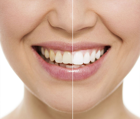 Teeth Whitening | Best At Partha Dental Clinic - Dentist 130