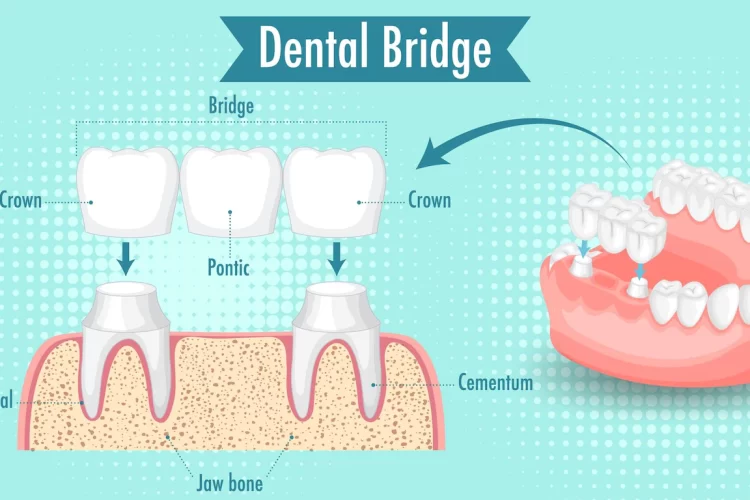 Dental Bridge And Crown