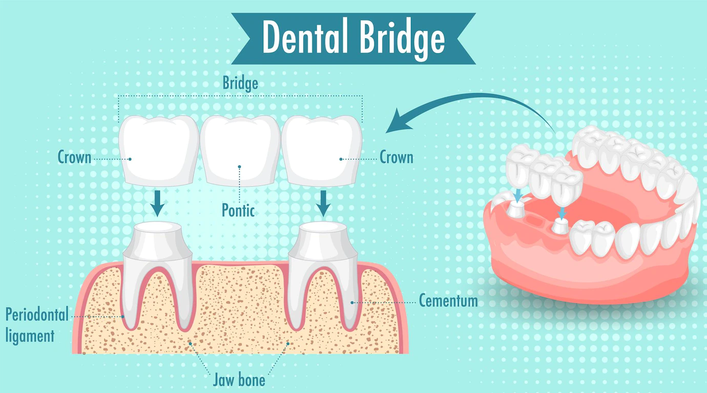 Implant Vs Dental Bridge - Best Dental Clinic Partha 130+