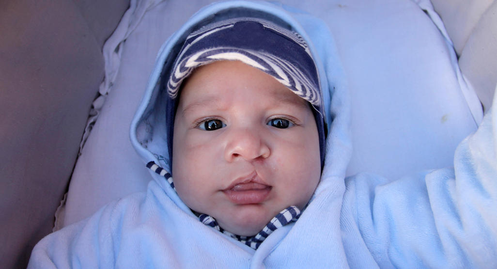 CLEFT LIP AND CLEFT PALATE