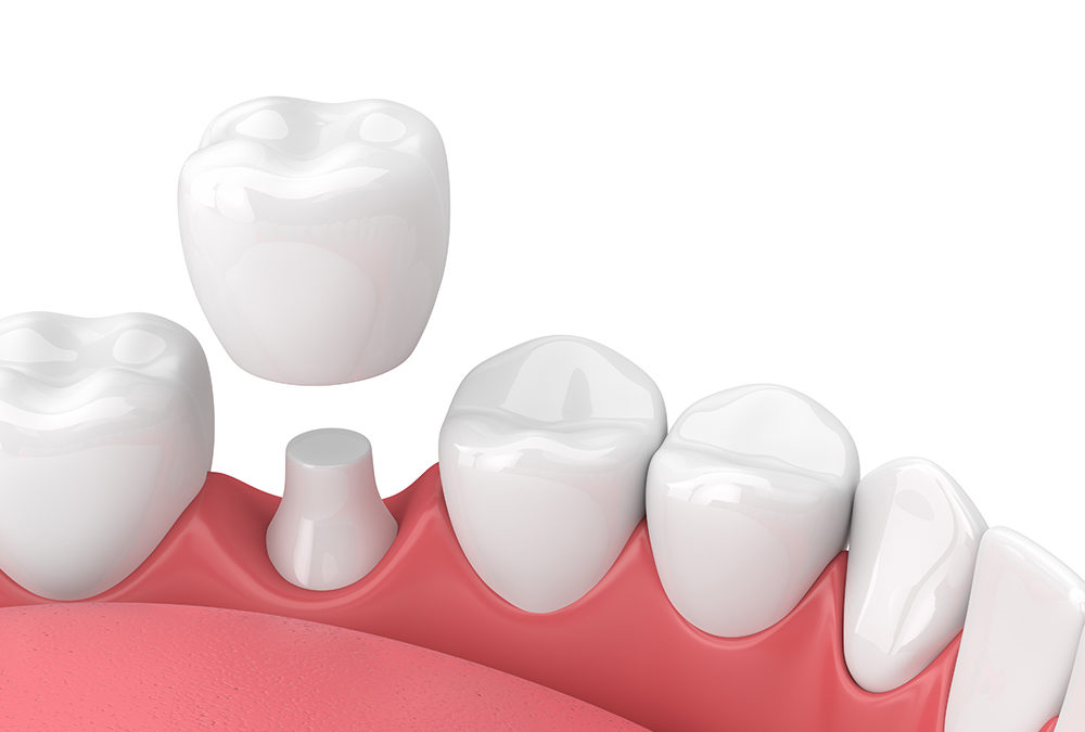 tooth crown treatment