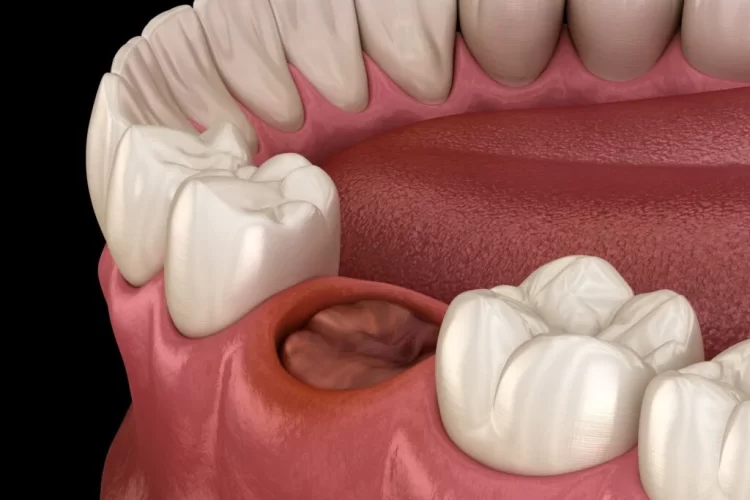 Dry Socket after Tooth Extraction