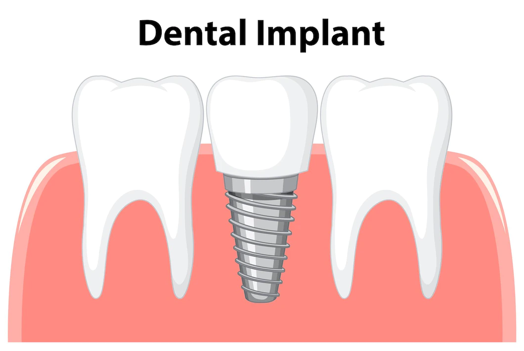 tooth implants clinic