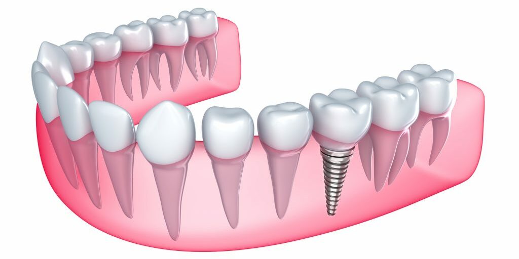 teeth implants treatment