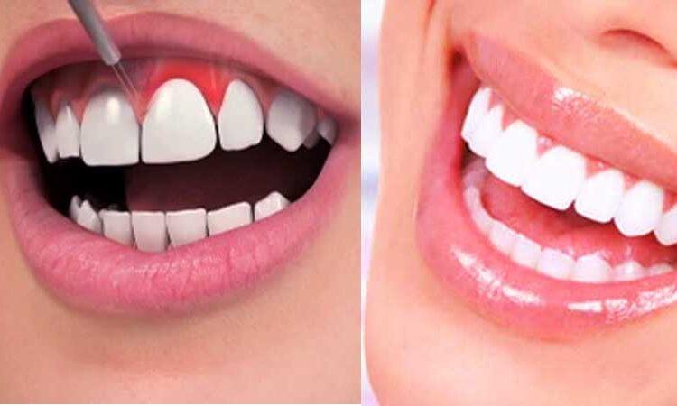 gum contouring treatment