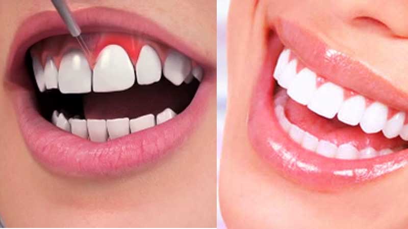 gum contouring treatment