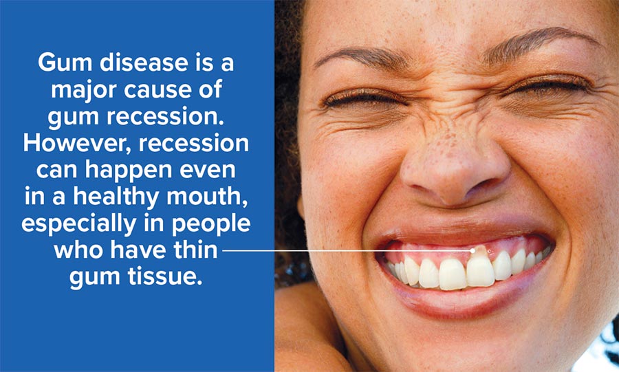 gum recession treatment