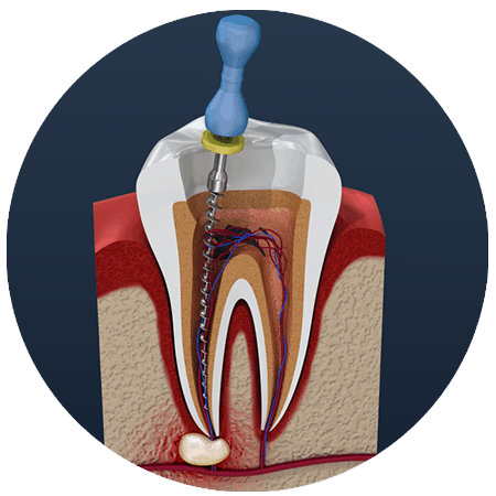 Rootcanal treatment in dental clinic