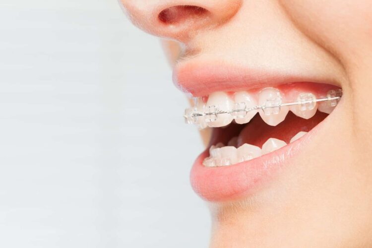 about ceramic braces Treatment