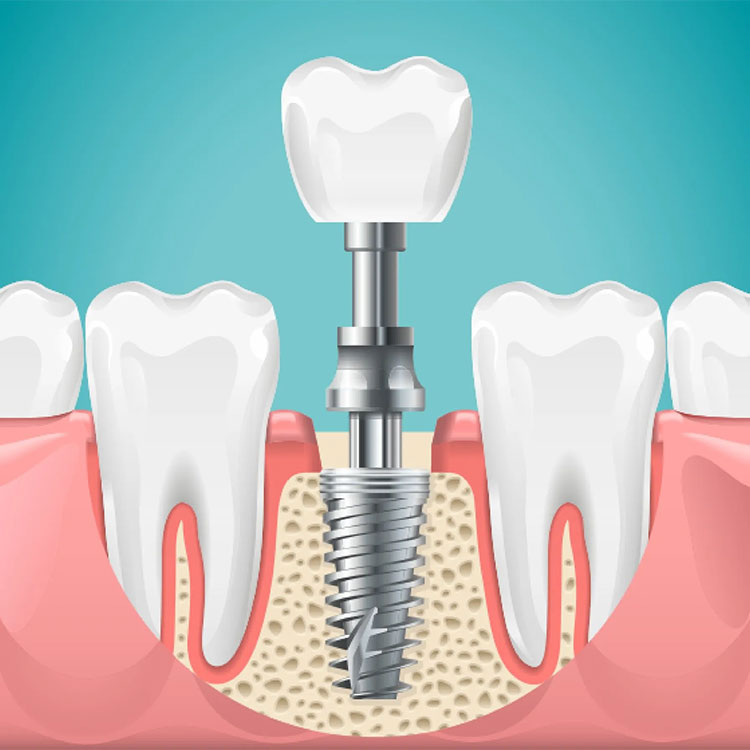 Best Dental Implants Clinic | Partha Dental Clinic 130+