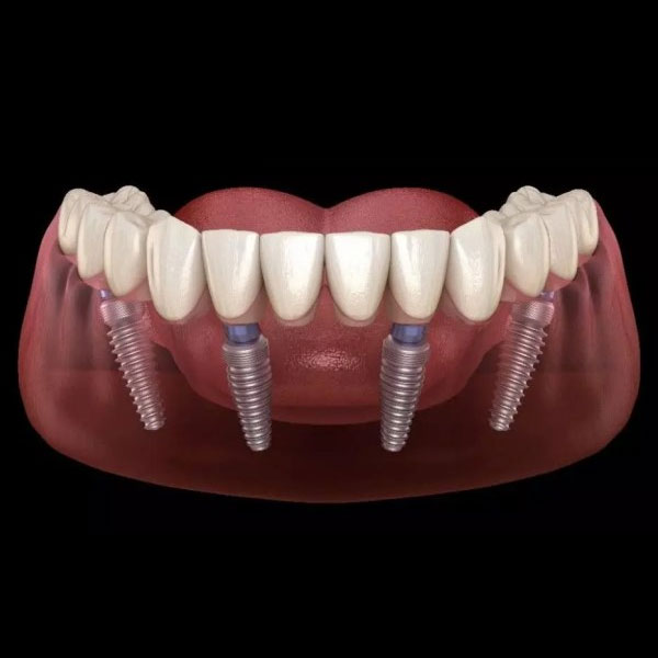 Full Mouth Dental Implants | Partha Dental Clinic - 130+
