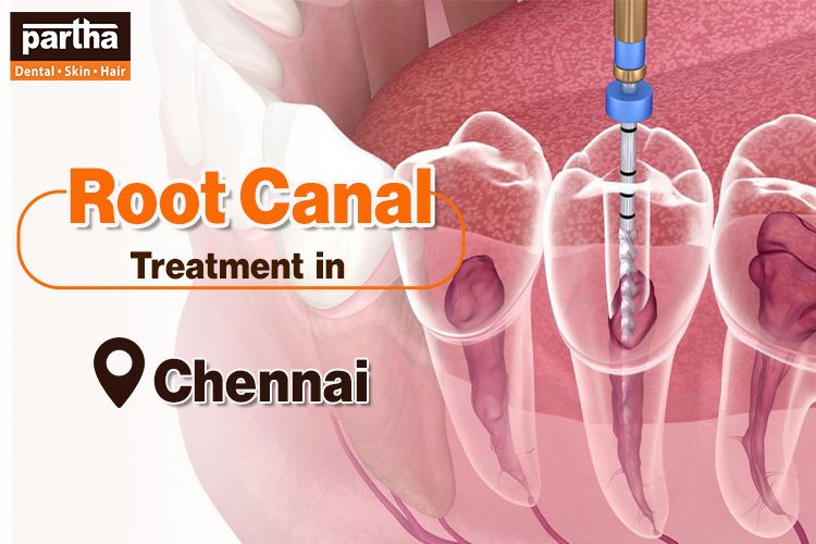 Root Canal Treatment (RCT) in Chennai: Symptoms, Procedure, Cost and Care 1 Root Cana Treatment Chennai
