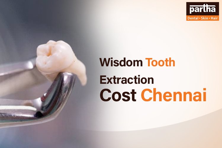 Wisdom Tooth Extraction in Chennai