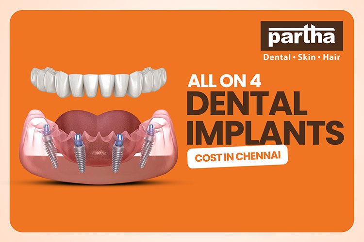 All on 4 implants in chennai