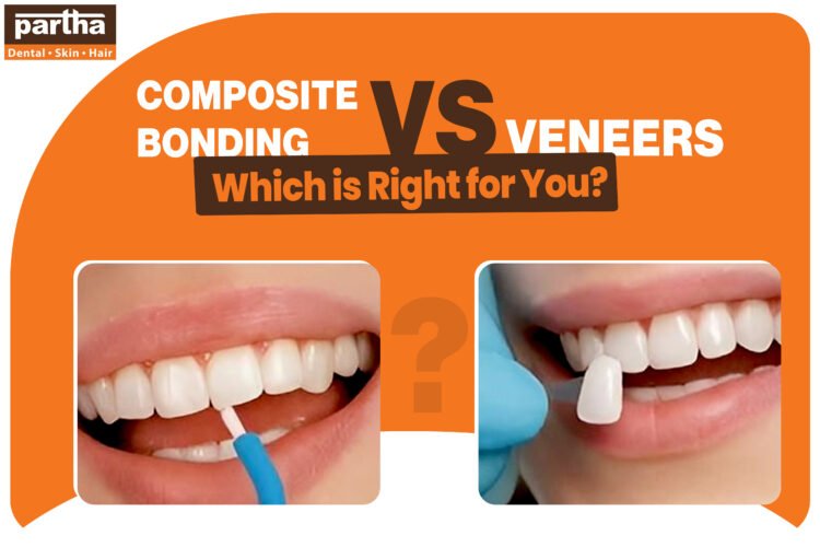 Composite Bonding vs Veneers 1