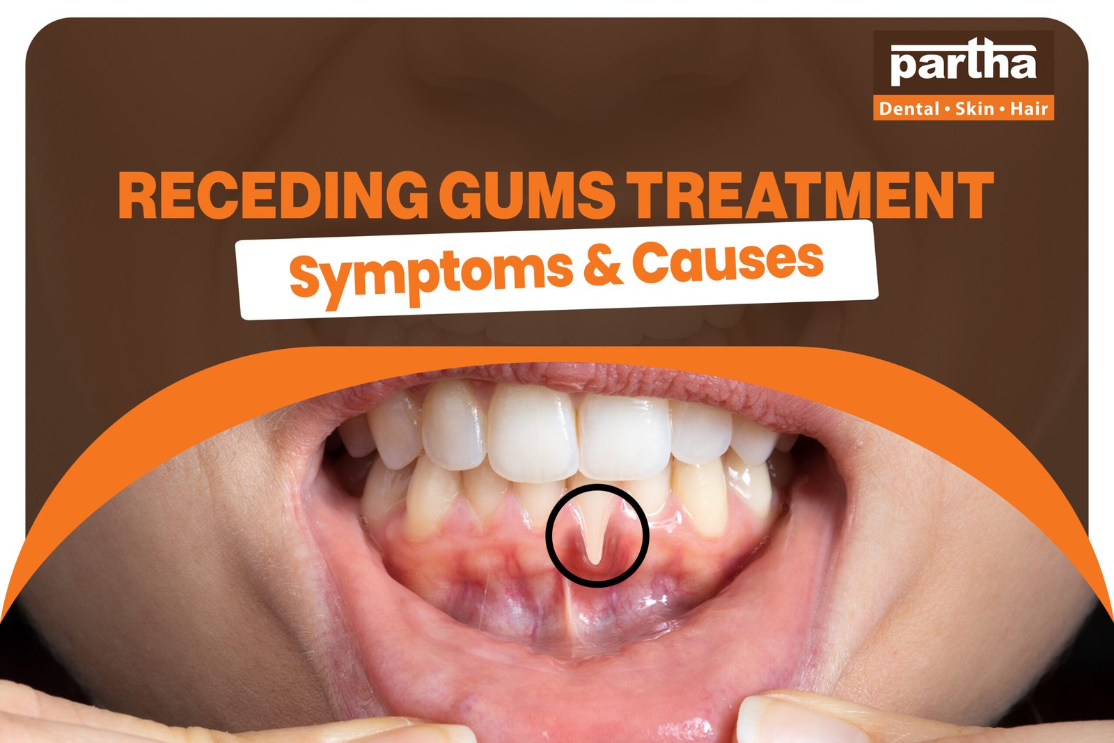 Receding Gums Treatment 1 scaled