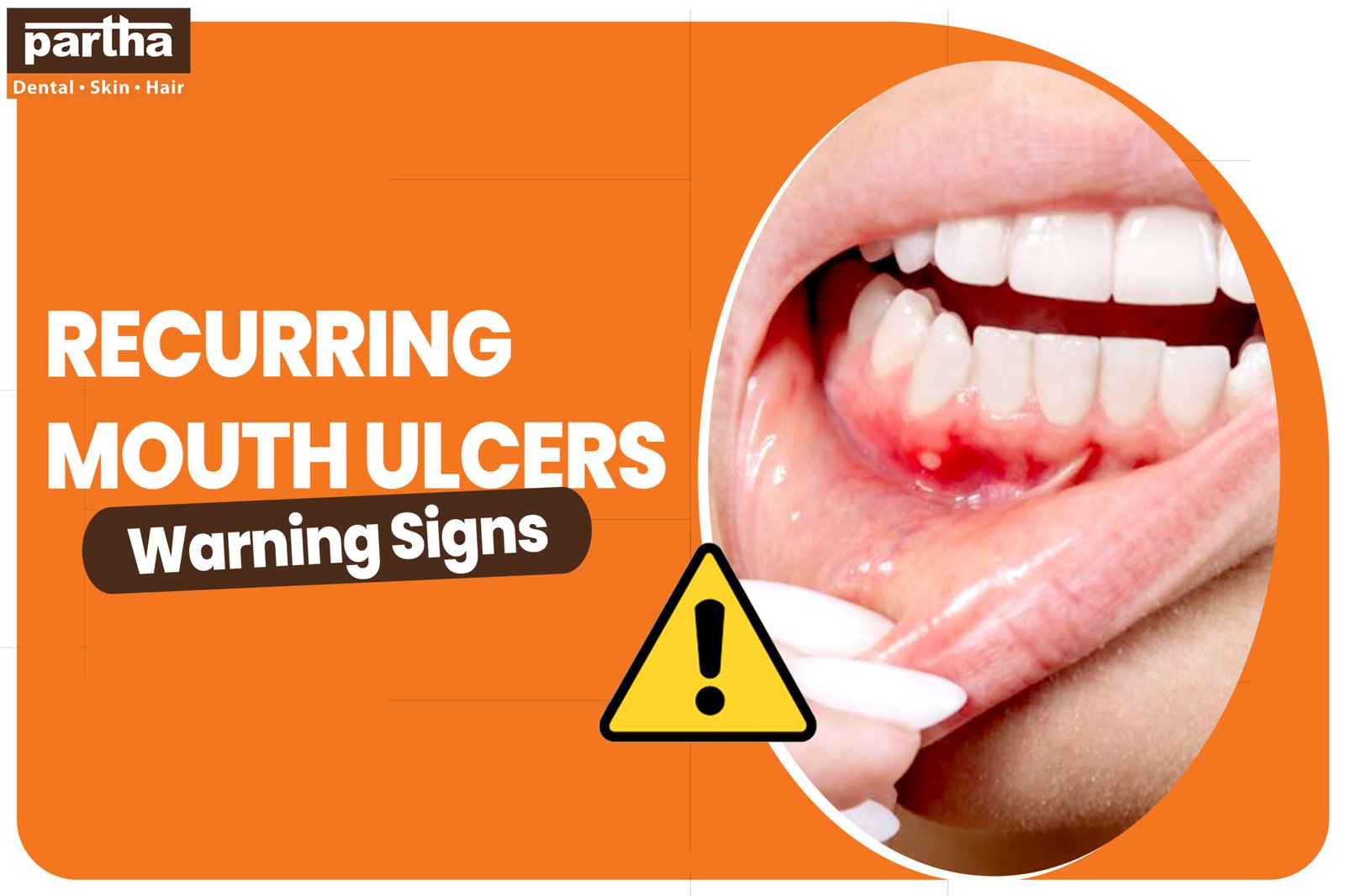 Recurring Mouth Ulcers scaled