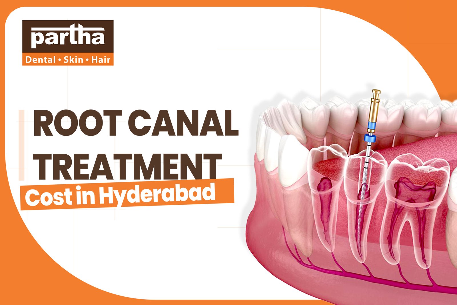 Root Canal treatment scaled