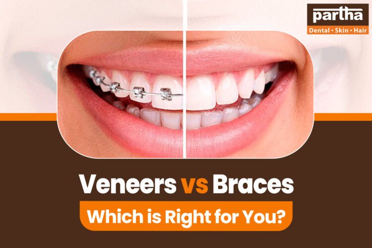Veneers vs Braces 1