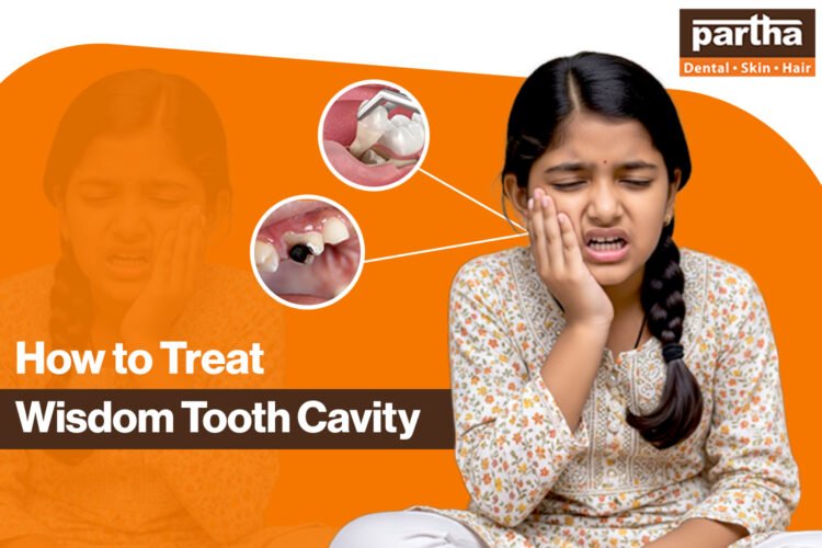 Wisdom Tooth Cavity 750 500 1