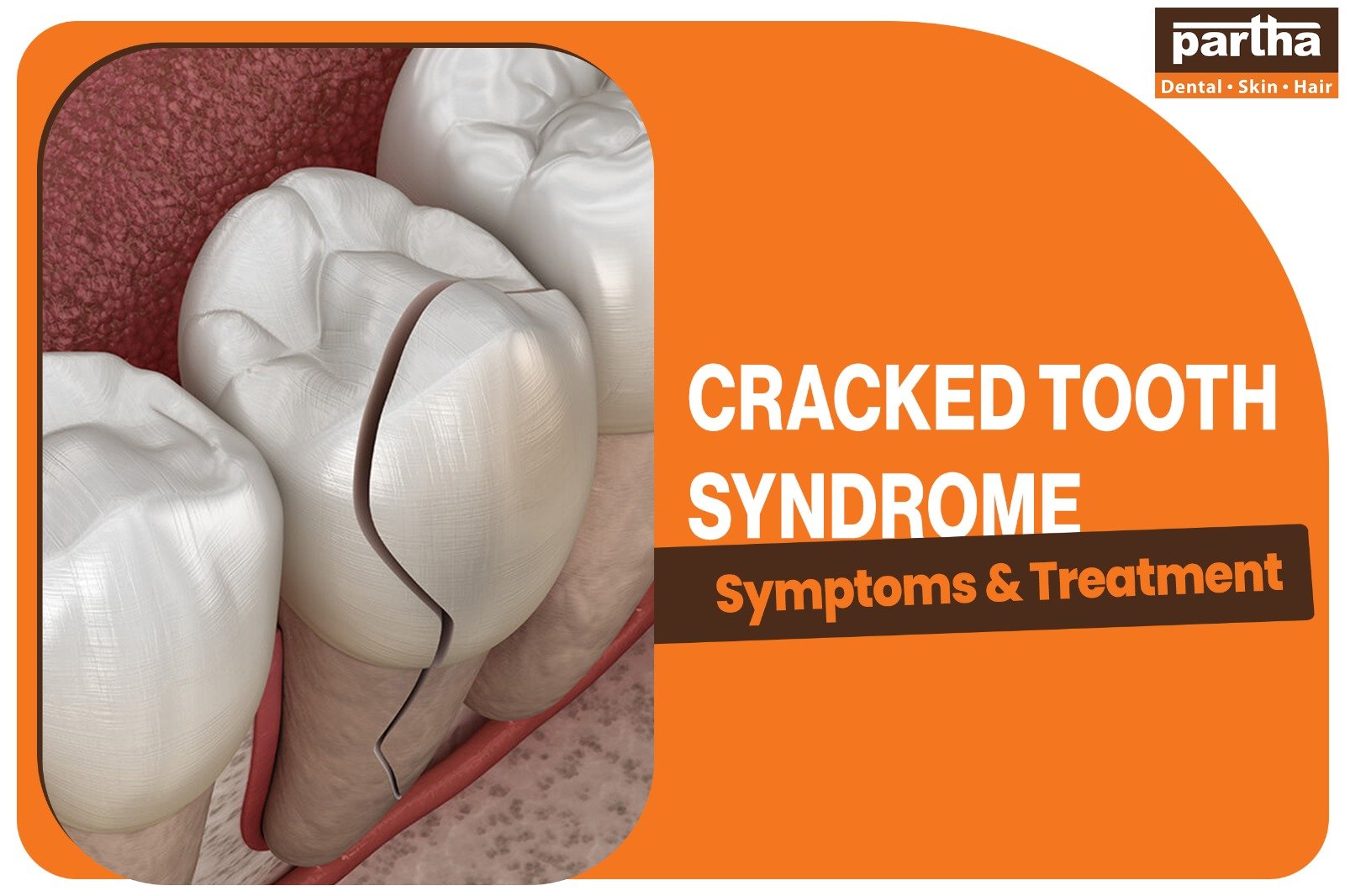 cracked tooth syndrome 1