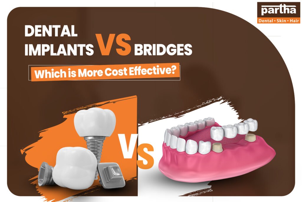 Dental Implants Vs Bridges Cost | Which Is More Affordable?
