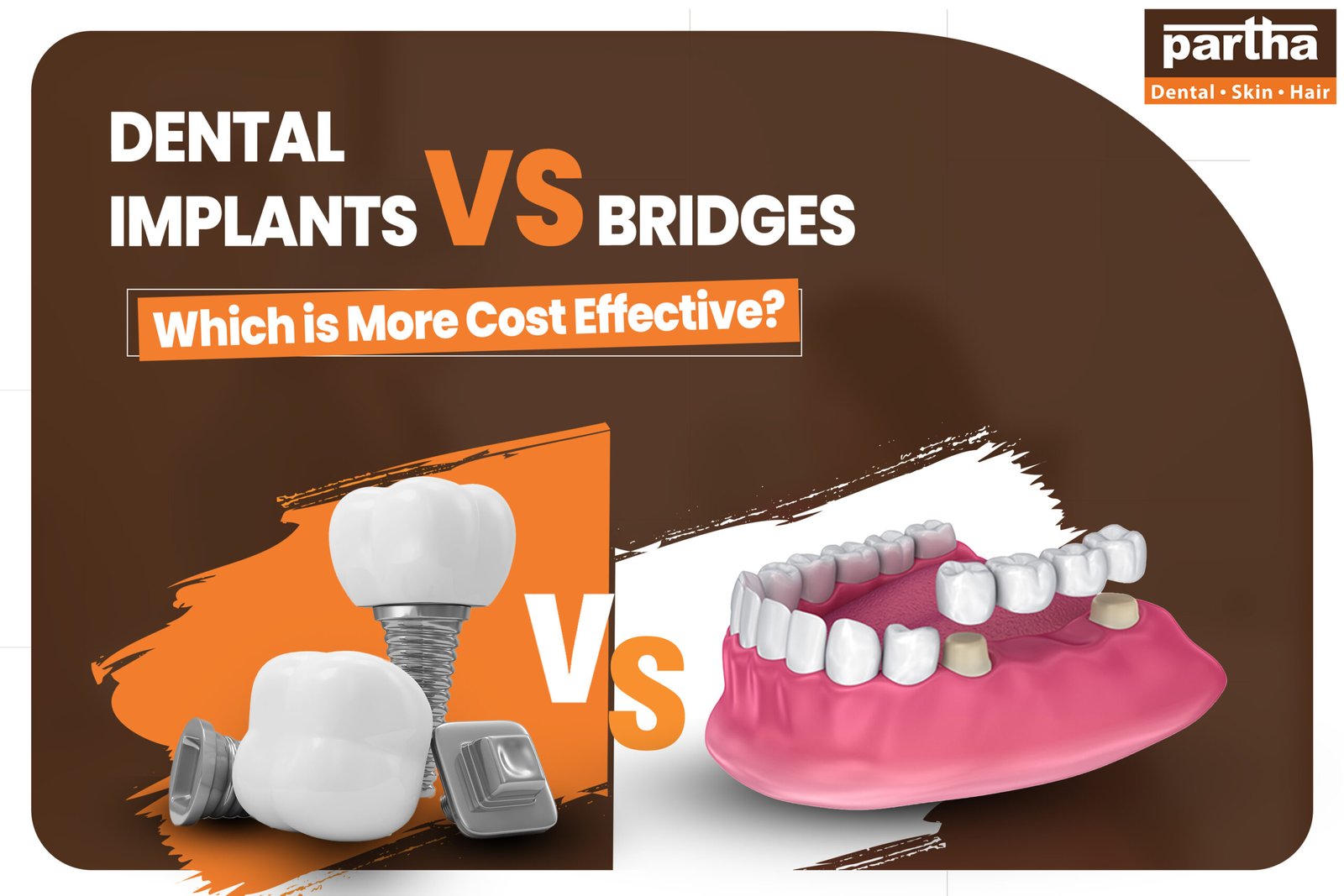dental implants vs bridges 2 scaled