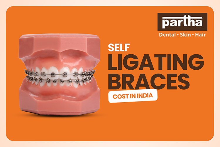 self ligating braces 1