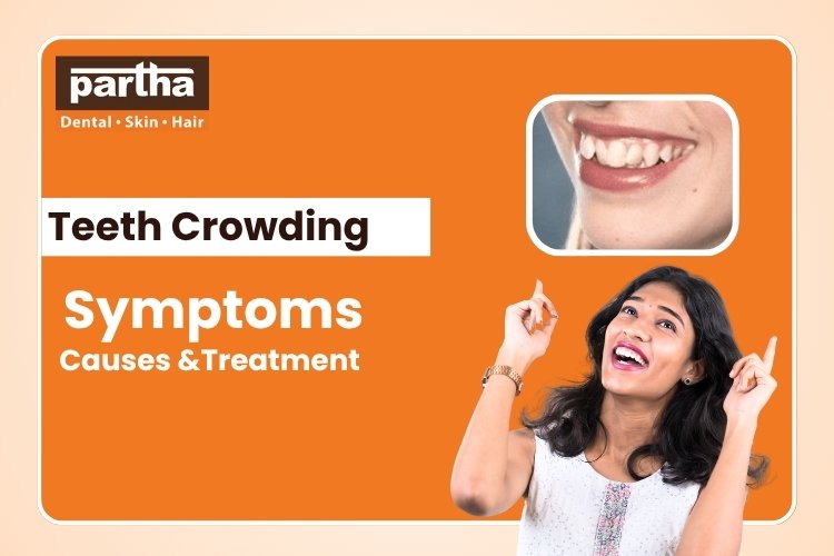 What is Teeth Crowding? Symptoms, Causes, and Treatment 1 teeth Crowding